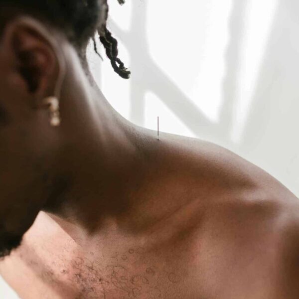 A man receiving acupuncture therapy on his shoulder for pain relief and wellness. National Motion Sickness treatment