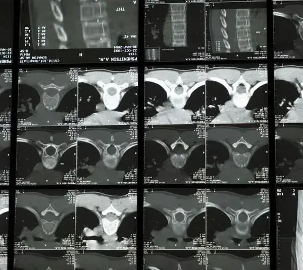 Scan of the spine in treatment for nervous system issues.